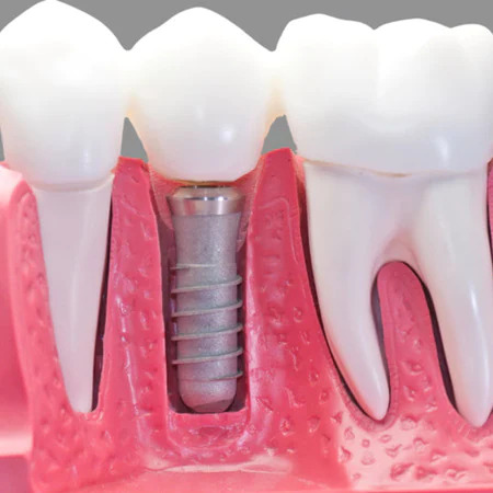 Dental Implants